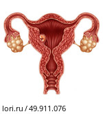Implanted human embryo concept and successful pregnancy implantation in the uterus as a growing fetus in a female body as an obstetrics and gynecology symbol with 3D illustration elements. Стоковое фото, агентство Ingram Publishing / Фотобанк Лори