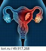 Uterus cancer and endometrial malignant tumor as a uterine medical concept as dangerous growing cells in a female body attacking the reproductive system as a symbol of cervical disease treatment diagnosis and symptoms with 3D illustration elements. Стоковое фото, агентство Ingram Publishing / Фотобанк Лори