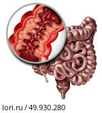 Crohna??s disease or crohn illness medical concept as a close up of a human intestine with inflammation symptoms causing obstruction as a 3D illustration. Стоковое фото, агентство Ingram Publishing / Фотобанк Лори