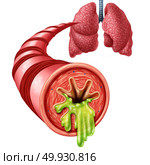 Bronchitis anatomy concept as an inflammation of bronchial tube lining with thick mucus secreted as a chest cold as a 3D illustration elements. Стоковое фото, агентство Ingram Publishing / Фотобанк Лори