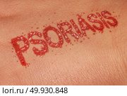 Psoriasis autoimmune disease as dry red skin patches as a symbol for dermatology illness in a 3D illustration style. Стоковое фото, агентство Ingram Publishing / Фотобанк Лори