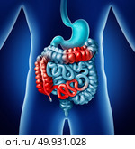 Crohn illness and intestine disease or crohns medical concept as human digestive colon with inflammation symptoms causing obstruction as a 3D illustration. Стоковое фото, агентство Ingram Publishing / Фотобанк Лори