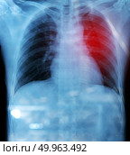 X-ray film of chest and stomach under dome of the diaphragm red . X-ray film of chest and stomach under dome of the diaphragm red zone is pain. Стоковое фото, агентство Ingram Publishing / Фотобанк Лори