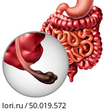 Appendix cancer and Intestine disease or gastrointestnal digestion with a malignant tumor symptoms and diagnosis problem as digestion discomfort or constipation and infection as a 3D illustration. Стоковое фото, агентство Ingram Publishing / Фотобанк Лори