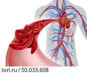 Sickle cell heart circulation blockage and anemia as a disease with normal and abnormal hemoglobin in a human artery anatomy with heart cardiovascular medical illustration concept with 3D illustration elements. Стоковое фото, агентство Ingram Publishing / Фотобанк Лори