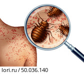 Bed bug bites on human skin  or bedbug infestation concept as a magnification close up of  parasitic insect pests as a hygiene symbol and health danger of bloodsucking parasites with 3D illustration elements. Стоковое фото, агентство Ingram Publishing / Фотобанк Лори