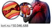 Myocardial infarction as a person suffering from a heart attack due to clogged coronary artery as a cardiology distress symbol with 3D illustration elements. Стоковое фото, агентство Ingram Publishing / Фотобанк Лори