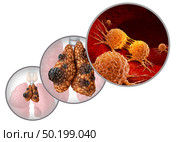 Thymus cancer disease or thymoma and thymic carcinoma illness as a gland anatomy sickness with growing malignant mutating cell growth as an icon isolated on a white background with 3D illustration elements. Стоковое фото, агентство Ingram Publishing / Фотобанк Лори