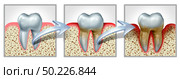 Tooth and gums disease medical dental chart concept with healthy teeth getting gingivitis and periodontitis resulting in inflammation and bone loss due to poor oral hygiene as a 3D illustration. Стоковое фото, агентство Ingram Publishing / Фотобанк Лори