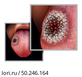 Tongue cancer medical concept or squamous cell carcinoma as malignant tumor disease in the mouth with 3D illustration elements. Стоковое фото, агентство Ingram Publishing / Фотобанк Лори