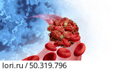 Blood clots health risk or thrombosis medical illustration concept symbol as a group of human blood cells clot clumped together by sticky platelets and fibrin as a blockage in an artery or vein as a 3D render. Стоковое фото, агентство Ingram Publishing / Фотобанк Лори
