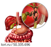 Bile duct cancer or cholangiocarcinoma with a gall bladder and liver as a disease of the digestive system representing a medical health care concept in human organ anatomy with 3D illustration elements. Стоковое фото, агентство Ingram Publishing / Фотобанк Лори