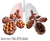 Emphysema as shortness of breath, lung disorder as a COPD illness and Chronic obstructive pulmonary disease medical concept as bronchioles and alveoli are damaged as a 3D illustration. Стоковое фото, агентство Ingram Publishing / Фотобанк Лори
