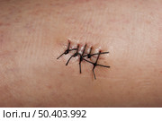 Close-up picture of a skin wound with stitches. Стоковое фото, агентство Ingram Publishing / Фотобанк Лори