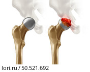 Femoral Head Disease and osteonecrosis or avascular necrosis and aseptic necrosis with a healthy hip compared to an osteoarthritis damaged pelvic joint in a 3D illustration style. Стоковое фото, агентство Ingram Publishing / Фотобанк Лори