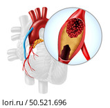 Heart Artery Bypass Grafting or CABG as an obstruction of plaque in the coronary artery or arteries as a vein from a leg that is grafted to a heart bypassing a blood circulation blockage in a 3D illustration style. Стоковое фото, агентство Ingram Publishing / Фотобанк Лори