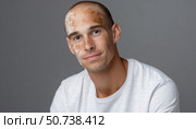 Young man showing vitiligo skin patches on face. Стоковое AI-изображение, AI-художник Юрий Поздников / Фотобанк Лори