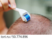 Man with early-stage baldness using a microneedling roller with sharp needles for scalp massage and hair regrowth treatment. Стоковое фото, фотограф Татьяна Степанищева / Фотобанк Лори