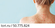 Back view of woman with red acne rash on skin, illustrating dermatological condition, inflammation, skin problems, or allergic reaction on light blue background. Стоковое AI-изображение, AI-художник Катерина Бондарец / Фотобанк Лори
