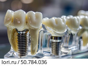 Dental implant model showing teeth and bone structure. Стоковое AI-изображение, AI-художник Иван Рябоконь / Фотобанк Лори