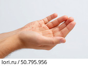 Human Hands with Painful Rash, Red Spots Blisters on the Skin. Health Problem. Monkeypox Disease Symptoms. Male Patient Arms with Monkey Pox. Close Up. Dengue Fever Infection, MPOX. Herpes, Pox Virus. Стоковое AI-изображение, AI-художник Марина Демидюк / Фотобанк Лори