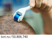 Hand using a microneedle roller on a balding scalp to stimulate hair growth. Hair loss treatment and scalp care concept. Стоковое фото, фотограф Татьяна Степанищева / Фотобанк Лори