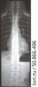 X-ray of the spine for examination by a doctor. Fractures, injuries or curvature of the back. The concept of medicine and science. Стоковое фото, фотограф Наталия Кирсанова / Фотобанк Лори