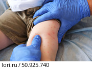 Doctor examining child with bodily red rash. Kid allergy closeup. Little baby scratches an eruption. Nurse applies special cream to atopic skin. Dermatitis, irritation, hive. Pruritus. Mosquito bites. Стоковое фото, фотограф Марина Демидюк / Фотобанк Лори