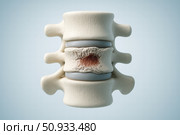 Detailed Anatomical Illustration of Human Vertebrae Highlighting Intervertebral Disc with Degeneration and Pathological Changes. Стоковое AI-изображение, AI-художник Башкирова Анна / Фотобанк Лори