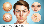 Illustration of Different Types of Acne on a Mans Face. Generative AI. Стоковое AI-изображение, AI-художник Roman Zavorotny / Фотобанк Лори