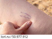 A woman examines blue spider veins on her leg. Telangiectasias, dilated capillaries showing through the skin. Стоковое фото, фотограф Коханова Наталья / Фотобанк Лори
