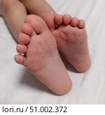 Dry feet peeling skin on feet. Air allergy, chemical allergy. Dermatitis. Eczema. Dyshidrosis. Baby feet. White background. Стоковое фото, фотограф Екатерина Топорова / Фотобанк Лори
