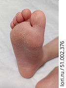 Dry feet peeling skin on feet. Air allergy, chemical allergy. Dermatitis. Eczema. Dyshidrosis. Baby feet. White background. Стоковое фото, фотограф Екатерина Топорова / Фотобанк Лори