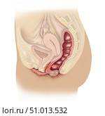 Rectocele affecting vaginal region. Стоковое фото, фотограф Elise Walmsley-MacWha/Stocktrek Images / ТАСС / Фотобанк Лори