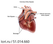 Coronary artery bypass of the human heart. Стоковое фото, фотограф Stocktrek Images, Inc. / ТАСС / Фотобанк Лори