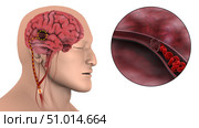 Medical illustration of an ischemic stroke. Стоковое фото, фотограф Stocktrek Images, Inc. / ТАСС / Фотобанк Лори