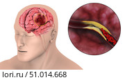 Medical illustration of an ischemic stroke. Стоковое фото, фотограф Stocktrek Images, Inc. / ТАСС / Фотобанк Лори
