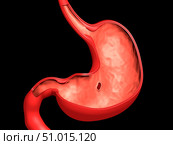 Conceptual image of peptic ulcer in human stomach. Стоковое фото, фотограф Stocktrek Images, Inc. / ТАСС / Фотобанк Лори