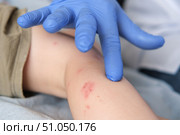 Doctor examining child with bodily red rash. Kid allergy closeup. Little baby scratches an eruption. Nurse applies special cream to atopic skin. Dermatitis, irritation, hive. Pruritus. Mosquito bites. Стоковое фото, фотограф Марина Демидюк / Фотобанк Лори