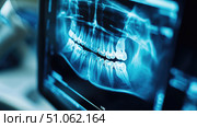 diagnostic x-ray of tooth scan ai generated. Стоковое AI-изображение, AI-художник Vectorwin / Фотобанк Лори
