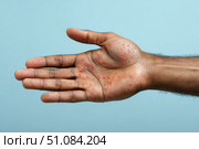 Human Hands with Painful Rash, Red Spots Blisters on the Skin. Health Problem. Monkeypox Disease Symptoms. Male Patient Arms with Monkey Pox. Close Up. Dengue Fever Infection, MPOX. Herpes, Pox Virus. Стоковое AI-изображение, AI-художник Марина Демидюк / Фотобанк Лори