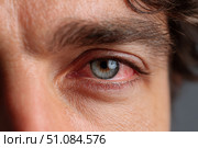 Human Eye with Conjunctivitis extreme close up. Closeup irritated infected red bloodshot eye. Male Eye. Vision. Eyesight. Adult Pain Eye Opening Wide. Viral infection with redness of eyeball. Macro. Стоковое AI-изображение, AI-художник Марина Демидюк / Фотобанк Лори