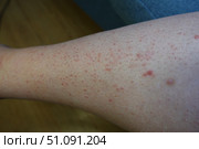 Красная сыпь на коже ноги, псориаз. Red rash on the leg skin, psoriasis. Стоковое фото, фотограф Юрий Пуликов / Фотобанк Лори