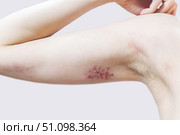 Woman with shingles on the skin she feels very painful. Стоковое фото, фотограф Anastasia Kayander / Фотобанк Лори