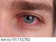 Human Eye with Conjunctivitis extreme close up. Closeup irritated infected red bloodshot eye. Male Eye. Vision. Eyesight. Adult Pain Eye Opening Wide. Viral infection with redness of eyeball. Macro. Стоковое AI-изображение, AI-художник Марина Демидюк / Фотобанк Лори