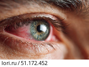 Human Eye with Conjunctivitis extreme close up. Closeup irritated infected red bloodshot eye. Male Eye. Vision. Eyesight. Adult Pain Eye Opening Wide. Viral infection with redness of eyeball. Macro. Стоковое AI-изображение, AI-художник Марина Демидюк / Фотобанк Лори