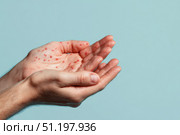 Human Hands with Painful Rash, Red Spots Blisters on the Skin. Health Problem. Monkeypox Disease Symptoms. Male Patient Arms with Monkey Pox. Close Up. Dengue Fever Infection, MPOX. Herpes, Pox Virus. Стоковое AI-изображение, AI-художник Марина Демидюк / Фотобанк Лори