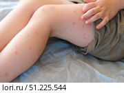 Child scratch body has sensitive itchy skin. Bodily rash. Kid allergy closeup. Little baby scratches eruption. Irritation, hive. Pruritus. Mosquito insect bite. Red from sunburn, Seborrheic Dermatitis. Стоковое фото, фотограф Марина Демидюк / Фотобанк Лори