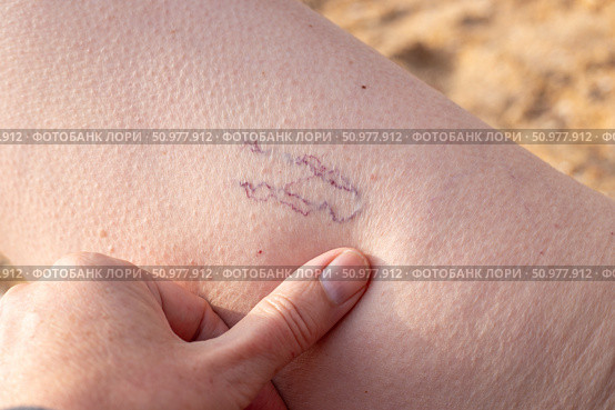 A woman examines blue spider veins on her leg. Telangiectasias, dilated capillaries showing through the skin. Стоковое фото, фотограф Коханова Наталья / Фотобанк Лори