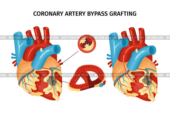Anatomy of heart with coronary artery bypass grafting flat vector illustration. Стоковая иллюстрация, агентство Ingram Publishing / Фотобанк Лори